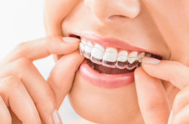 Aparelho Dentário Invisível – Ortodontia